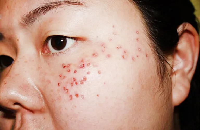 Bắn Laser Trị Nám Bao Lâu Thì Hết? 1 ban laser tri nam bao lau thi het 685568997750a
