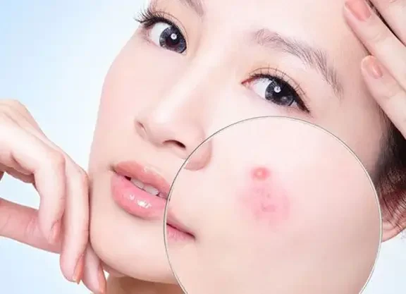 Có Nên Trị Mụn Bằng Công Nghệ Cao? 1 co nen tri mun bang cong nghe cao 6855689b750b3