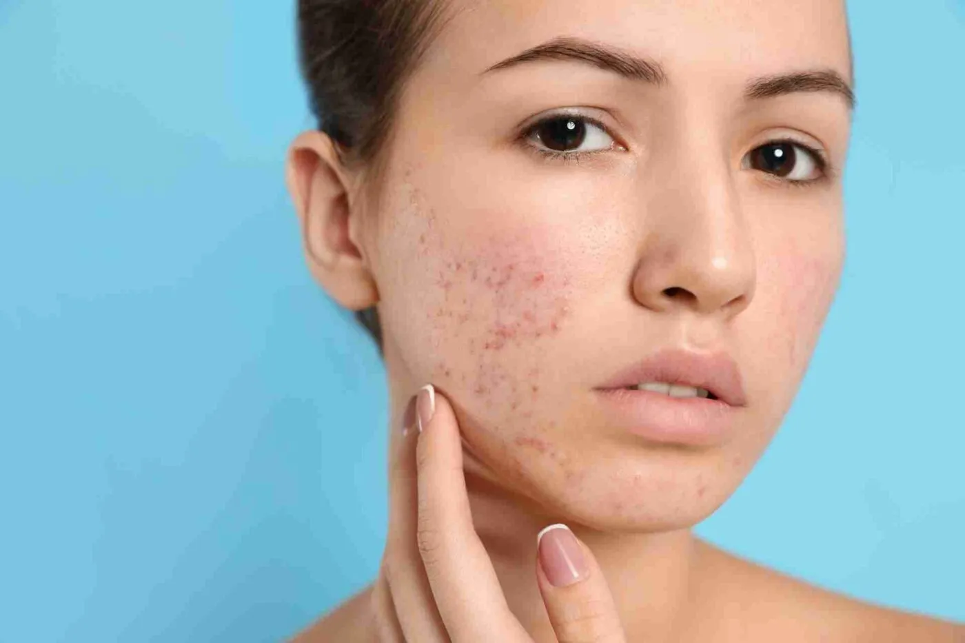 Da Nhạy Cảm Có Nên Peel Da Không? 1 da nhay cam co nen peel da khong 6855689ddf699