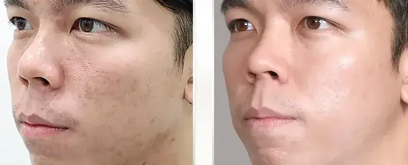 Liệu Trình Trị Sẹo Rỗ Bao Lâu? 1 lieu trinh tri seo ro bao lau 6855689581c97