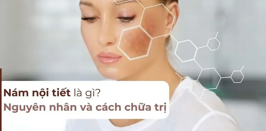 Nám do Nội Tiết Tố Có Trị Dứt Điểm Được Không? 17 nam do noi tiet to co tri dut diem duoc khong 68556863618b4
