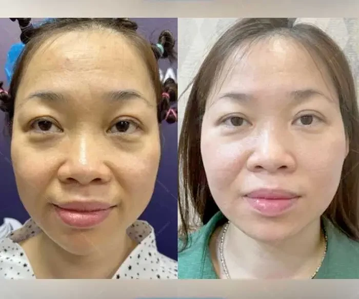 Nâng Cơ Mặt Không Phẫu Thuật Có Hiệu Quả Lâu Dài Không? 1 nang co mat khong phau thuat co hieu qua lau dai khong 685568820bd7b