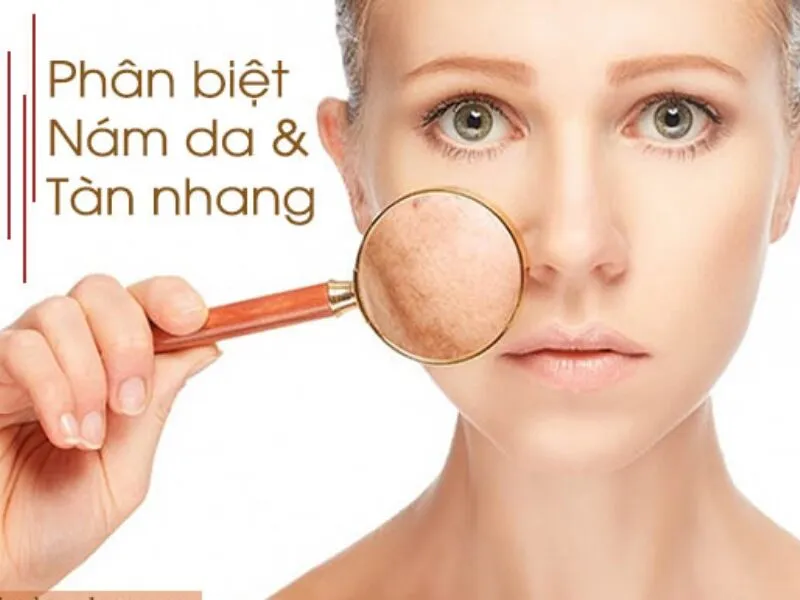 Làm Thế Nào Để Phân Biệt Nám và Tàn Nhang Bằng Mắt Thường? 1 phan biet nam va tan nhang bang mat thuong 6855686196cef