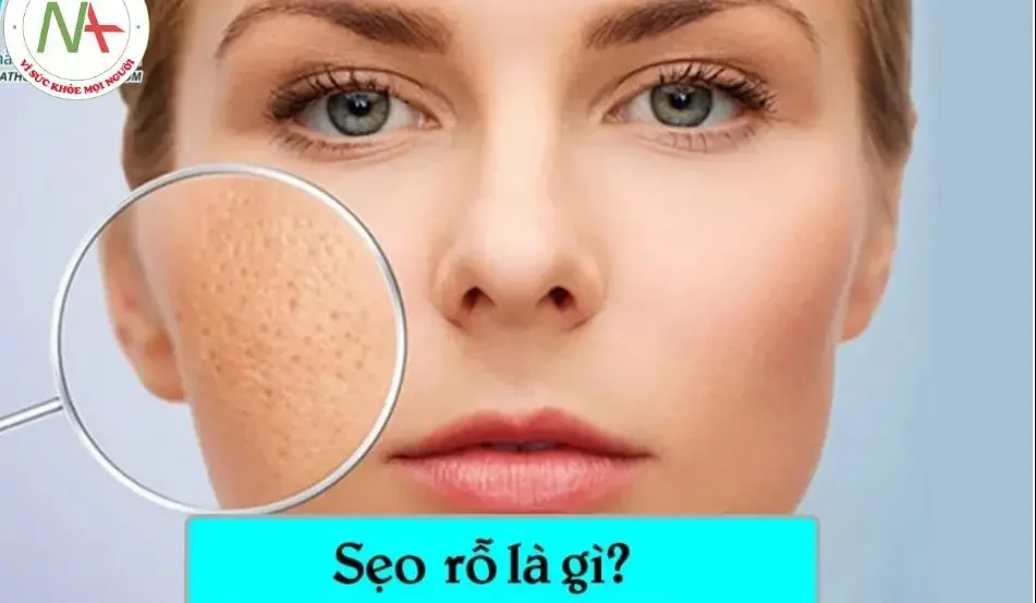 Sẹo Rỗ Có Trị Được Không? 1 seo ro co tri duoc khong 68556888d922e