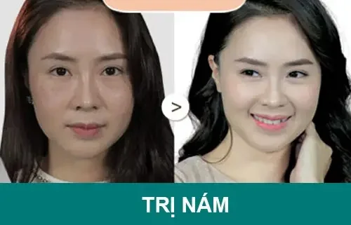 Trị nám bao nhiêu tiền 1 liệu trình? 1 tri nam bao nhieu tien 1 lieu trinh 685567f65144e