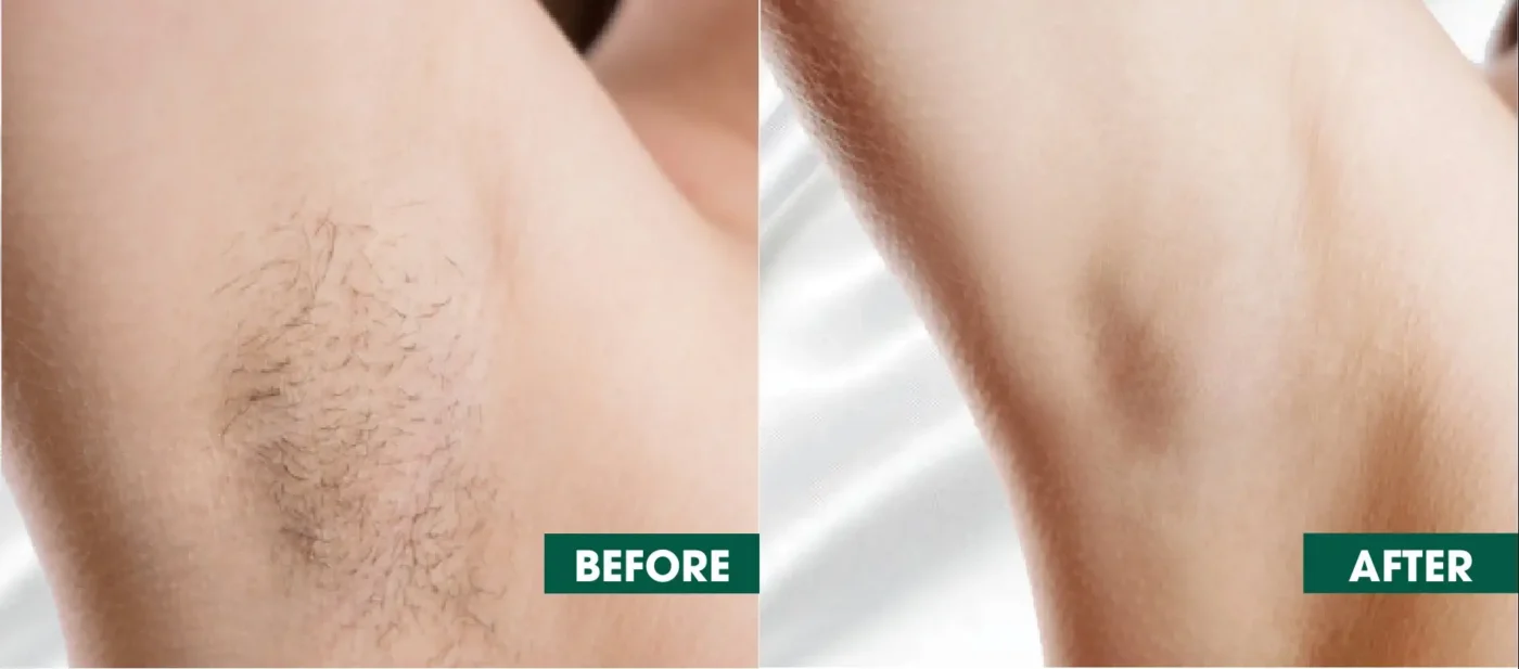 Triệt Lông Vĩnh Viễn Có Gây Hại Không? 12 triet long vinh vien co gay hai khong 68556874ab0f7